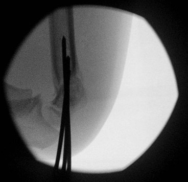 Supracondylar Lateral K Wires